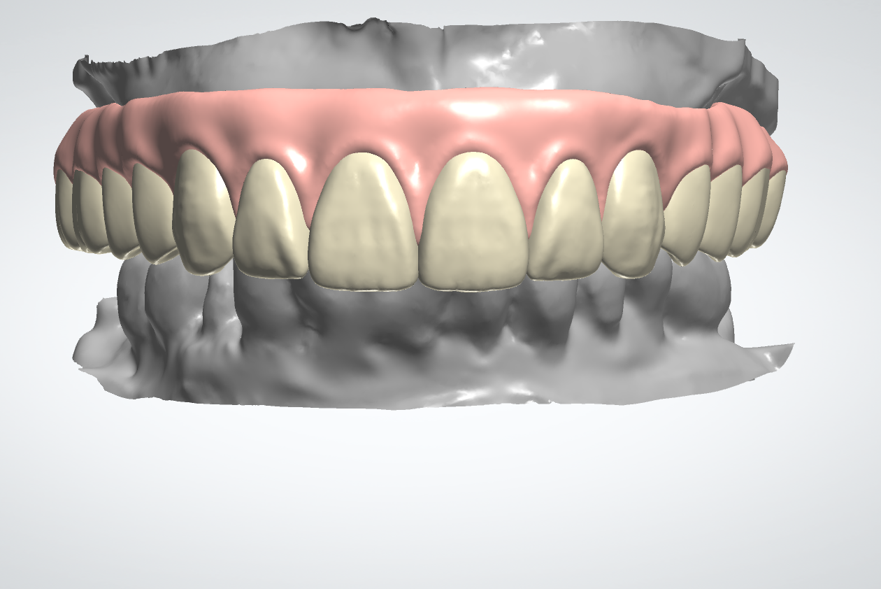 Gingiva Crown Example